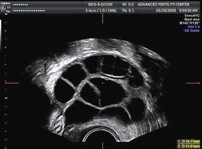 Woman self-administering fertility injection during IVF ovarian stimulation at home